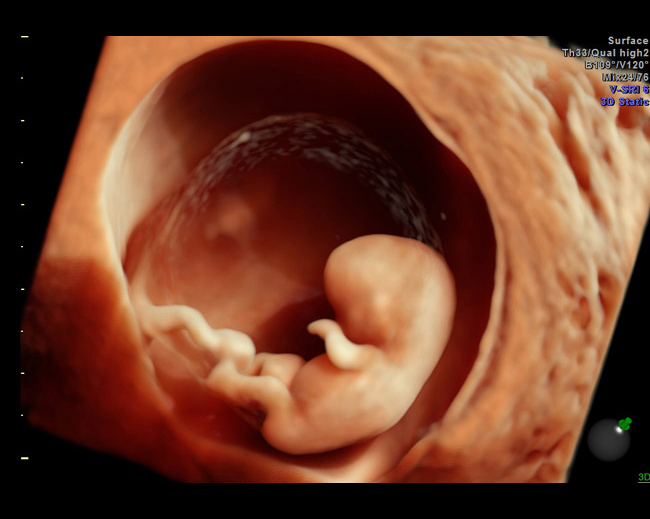 Hdlive-10-week-fetus
